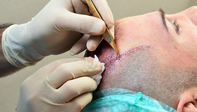 عملية زراعة شعر 